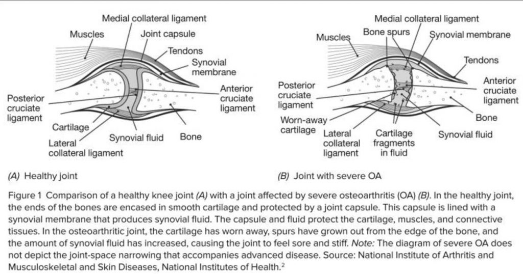 Representación gráfica de la osteoartritis