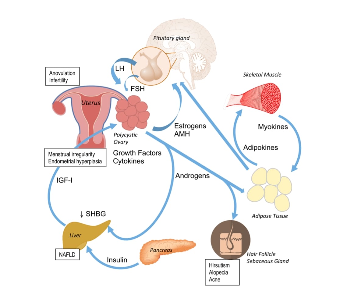 Fig 1. Representación esquemática de algunos mecanismos fisiopatológicos del síndrome de ovarios poliquísticos. 